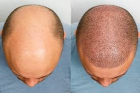 Transform Your Look with a Hair Transplant in Dubai