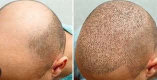 Expectations To Have From Hair Transplant